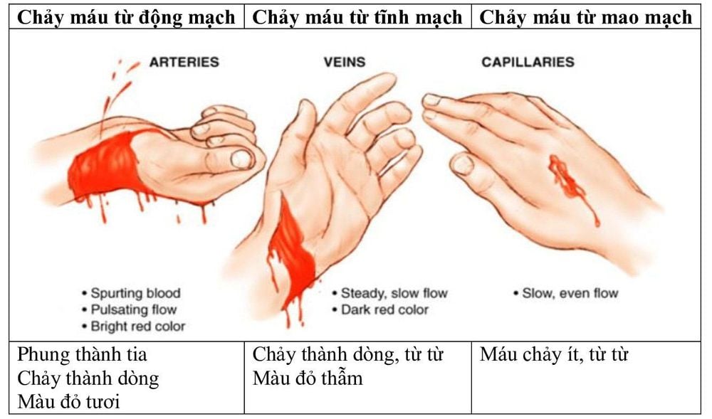 Chảy Máu Khó Cầm: Nguyên Nhân, Cách Xử Trí & Khi Nào Cần Cấp Cứu 8 Sơ cứu chảy máu khó cầm