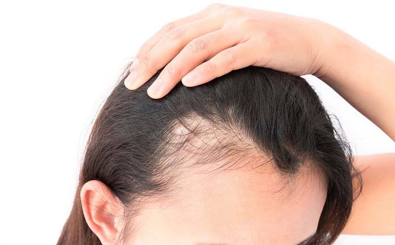 Hói đầu kiểu nam ở nữ: Nguyên nhân, dấu hiệu và phương pháp điều trị 8 Rụng tóc vùng đỉnh đầu ở nữ