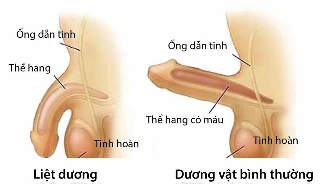 Rối loạn cương dương ở nam giới
