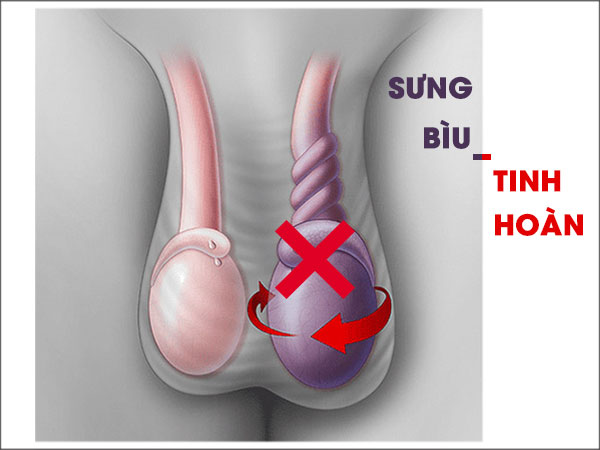 bìu sưng to căng tức