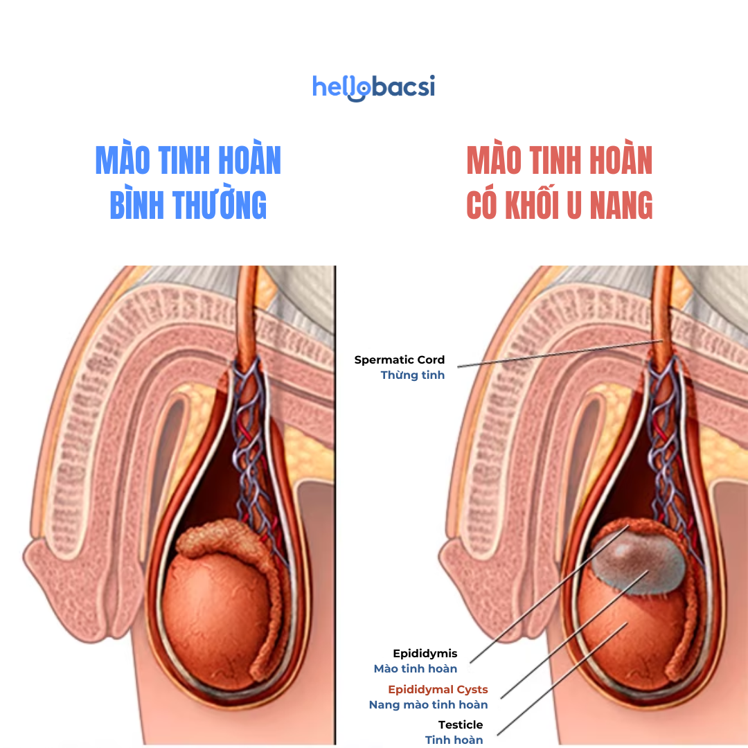 Vị trí và triệu chứng u tinh hoàn