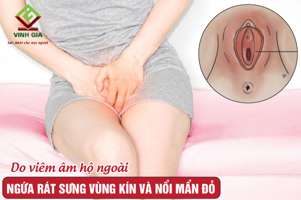 Ngứa rát vùng kín