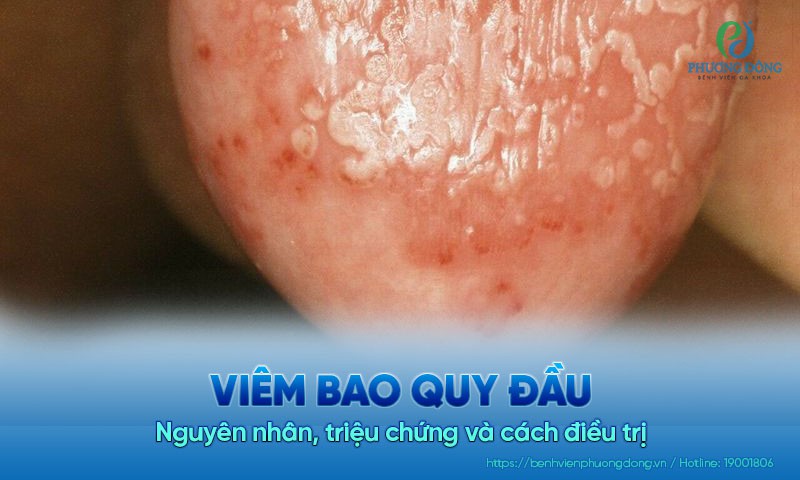 Viêm bao quy đầu do vi khuẩn và nấm