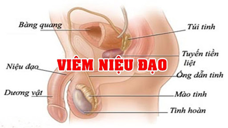 Viêm niệu đạo ở nam giới