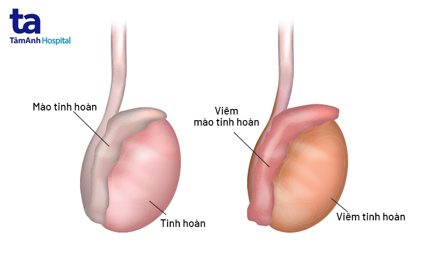 viêm tinh hoàn