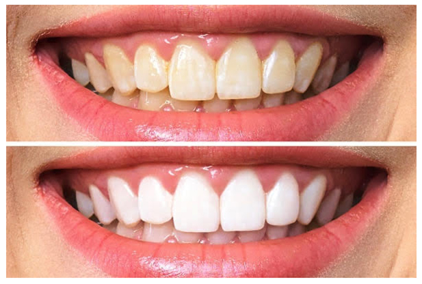 Tẩy trắng răng tại nhà