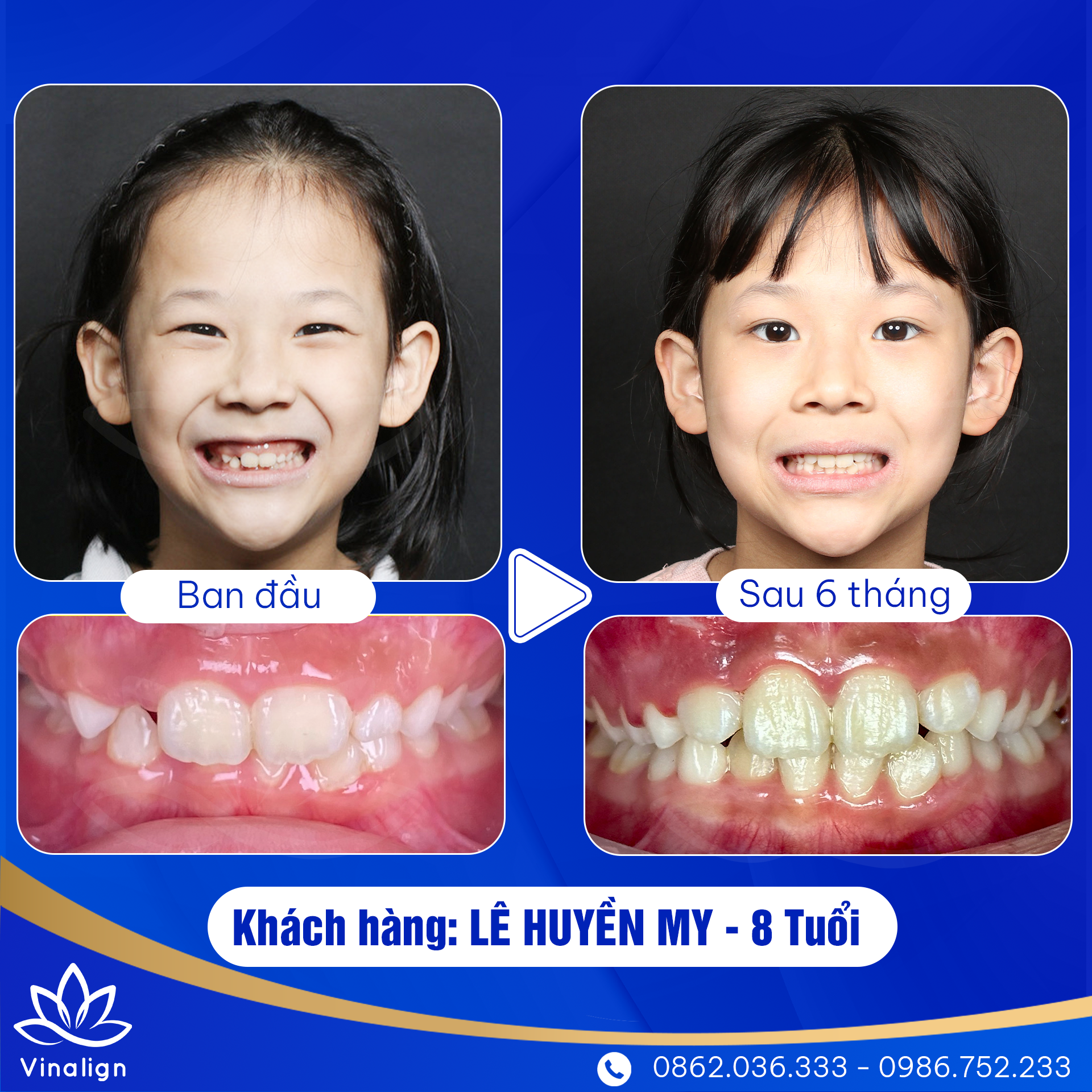 Khí cụ chỉnh nha tăng trưởng