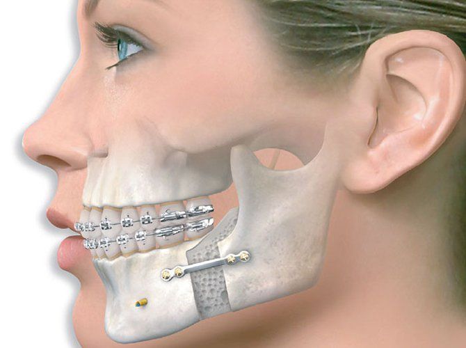 Hình ảnh nẹp cố định xương hàm