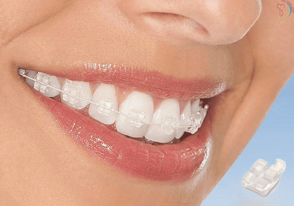 Niềng Răng Thẩm Mỹ