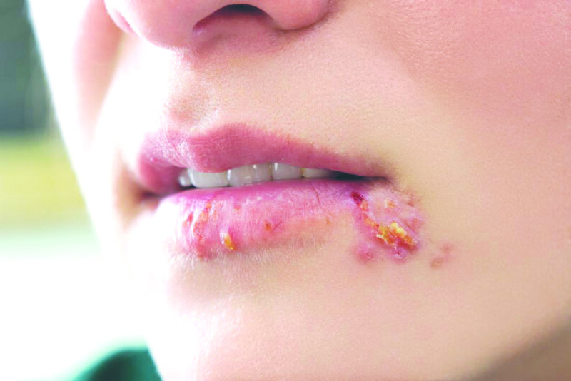Herpes miệng tiến triển