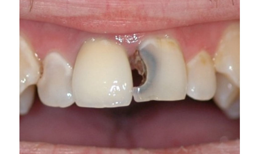 Răng cửa bị mẻ