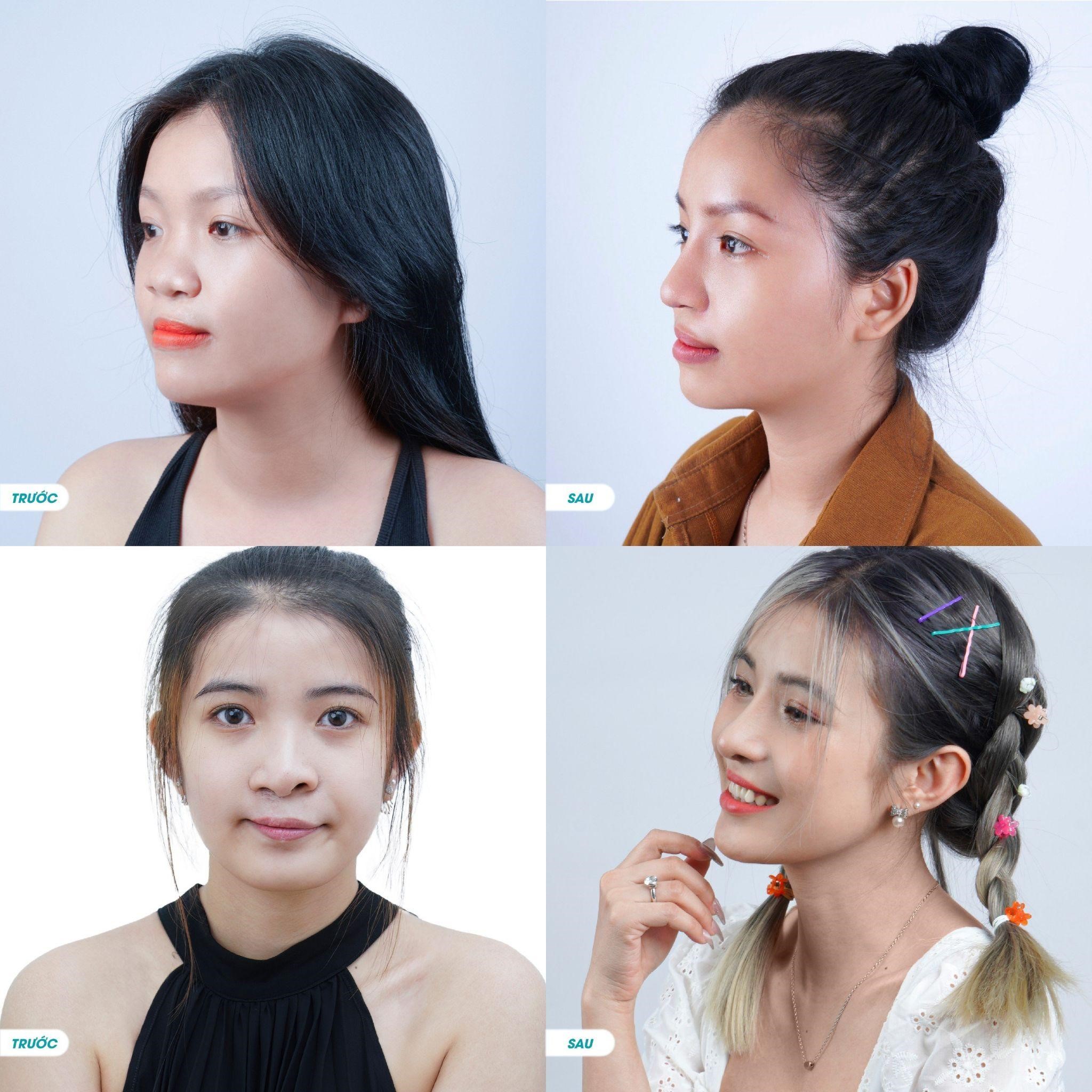 Phẫu thuật sửa vòm miệng