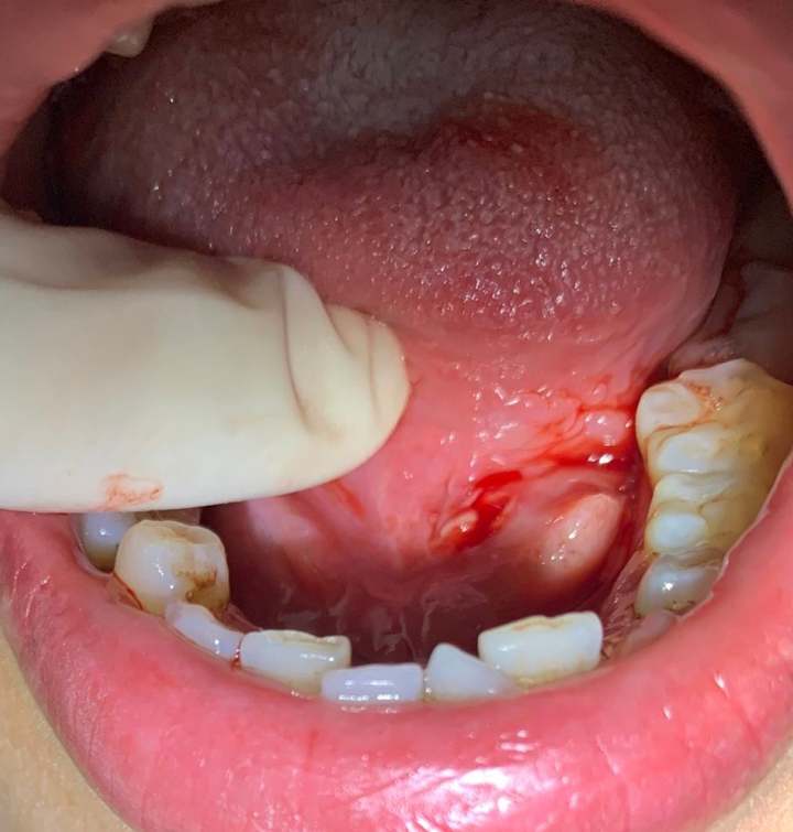 Triệu chứng viêm tuyến nước bọt