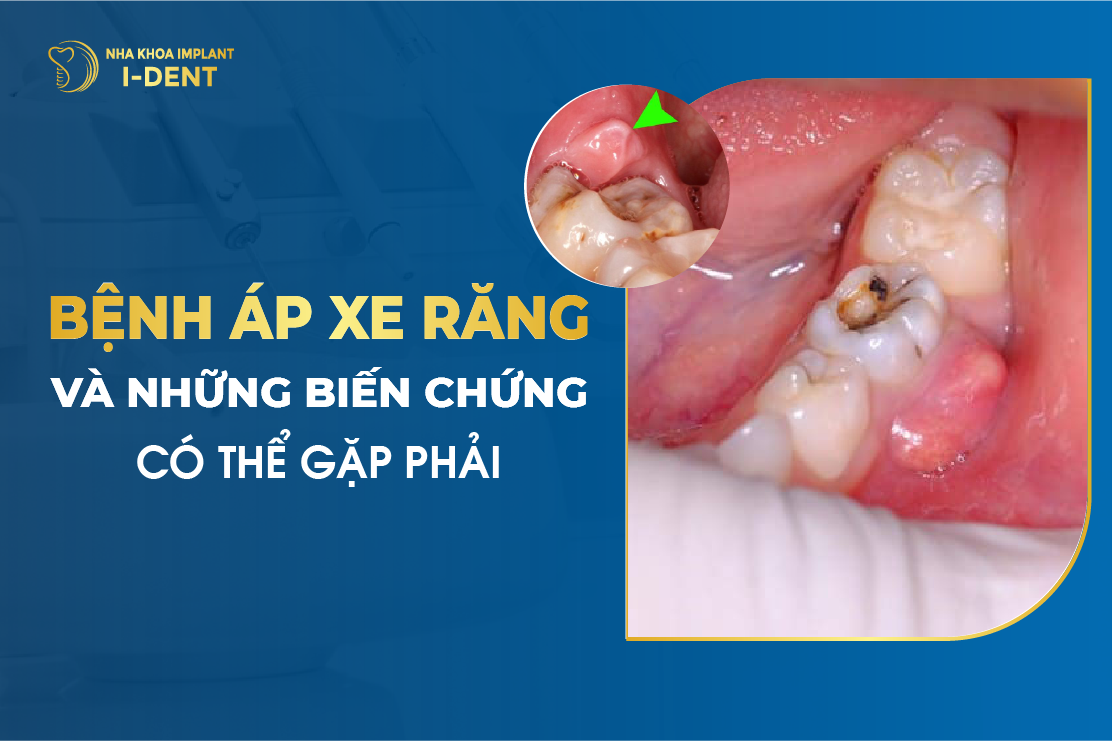 Biến chứng áp xe răng