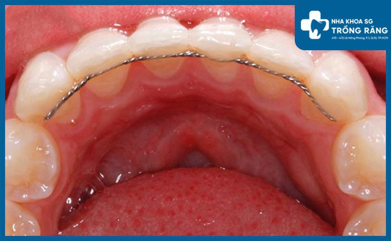 Kiểm tra răng định kỳ sau cố định
