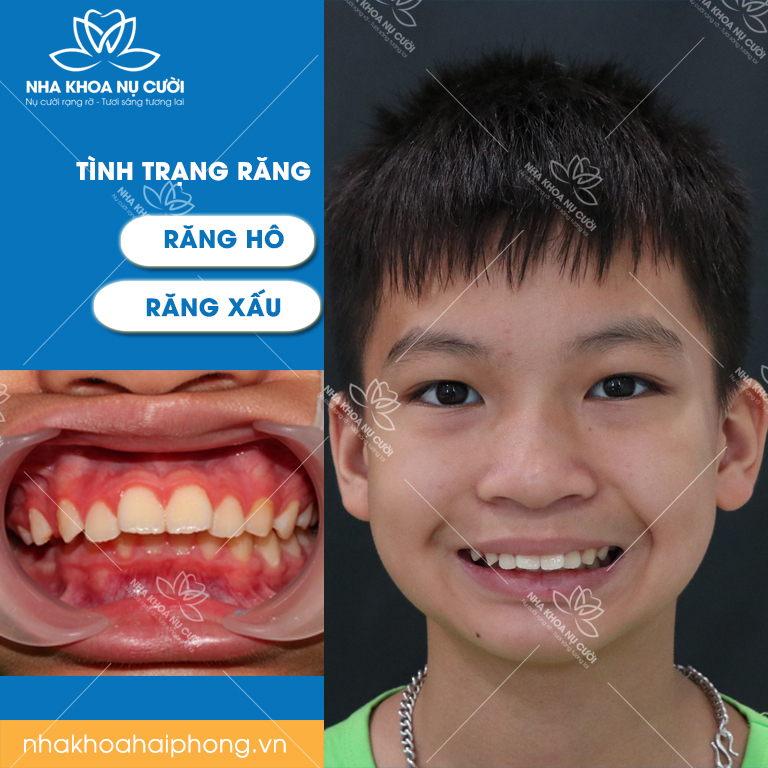 Răng Hô