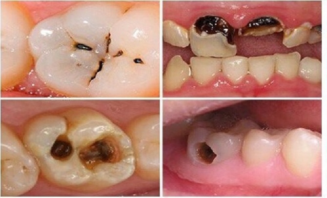 Hình ảnh răng bị sâu ở người lớn