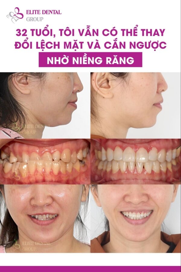 Sau thời gian niềng răng khớp cắn chéo