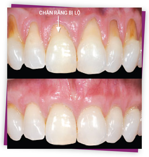 Ghép nướu tự do - Quy trình ghép nướu