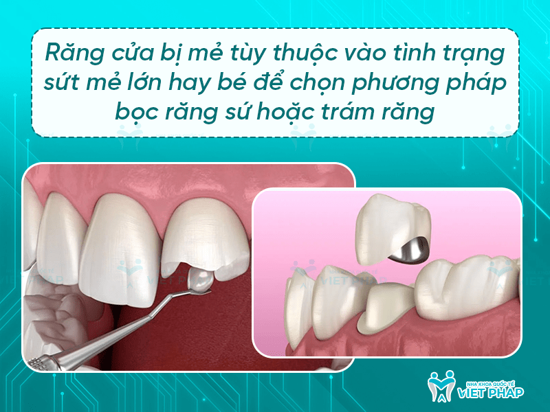 Trám răng cửa bị mẻ