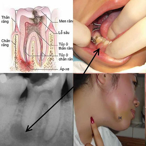 Áp xe nha chu nguy hiểm nếu không điều trị kịp thời