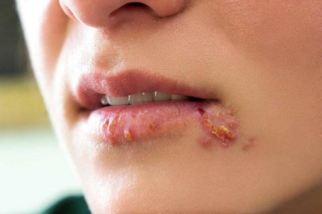 Herpes miệng giai đoạn đầu