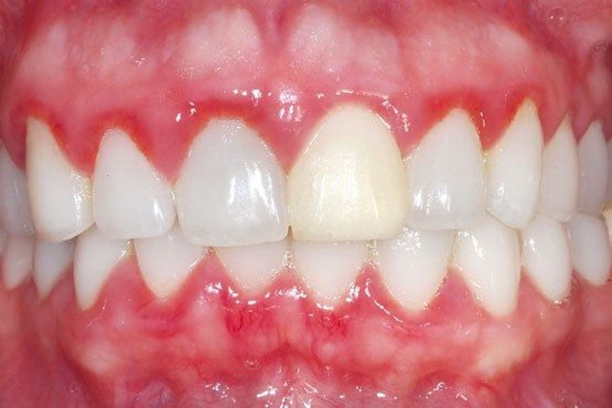 Nguyên nhân và biến chứng viêm nướu