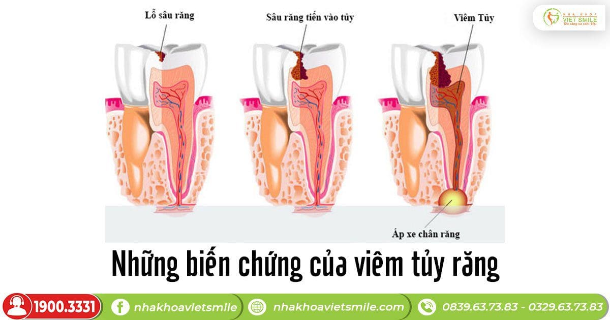 Biến chứng viêm tủy răng