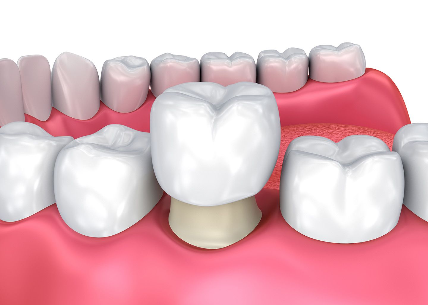 Lấy dấu răng và thiết kế răng sứ