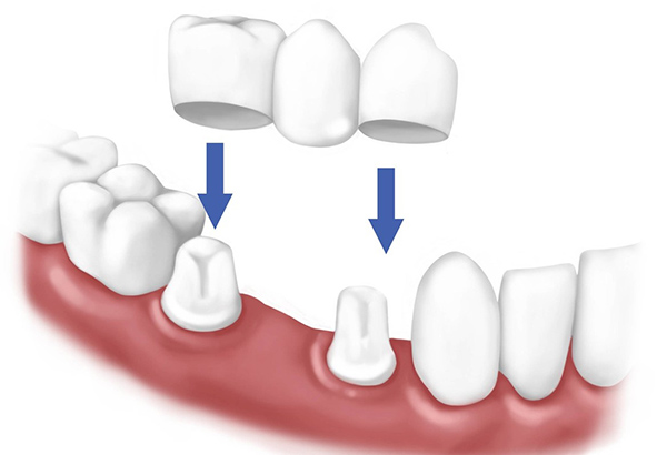 Bọc răng sứ thẩm mỹ
