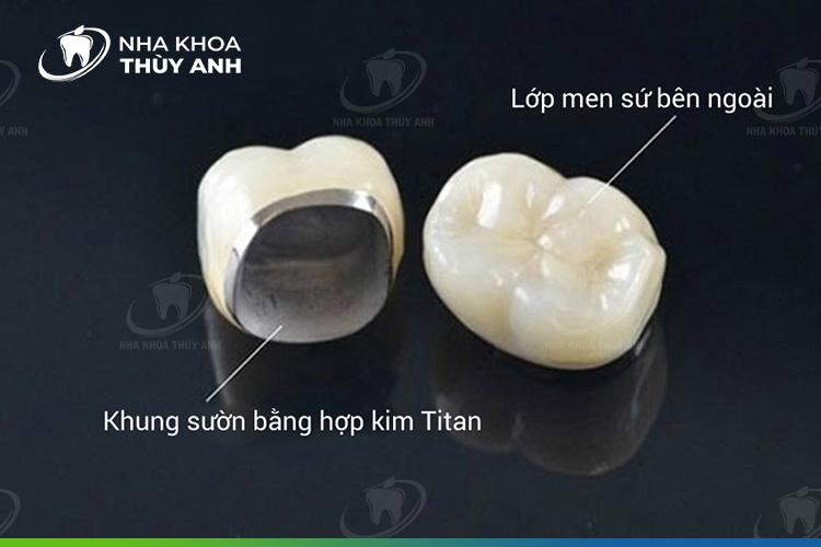 Bọc răng sứ titan