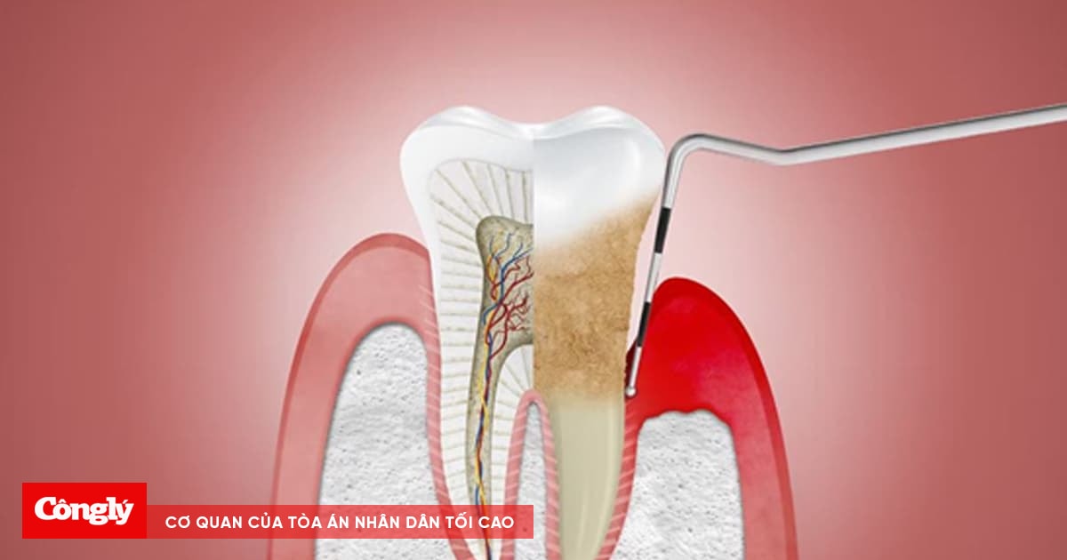 Viêm nha chu và điều trị bằng laser