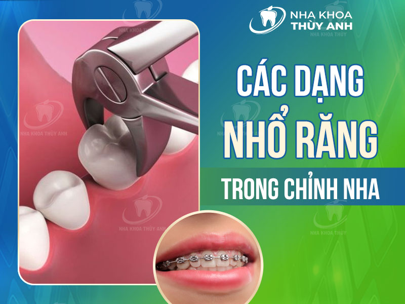 Các dạng nhổ răng trong chỉnh nha