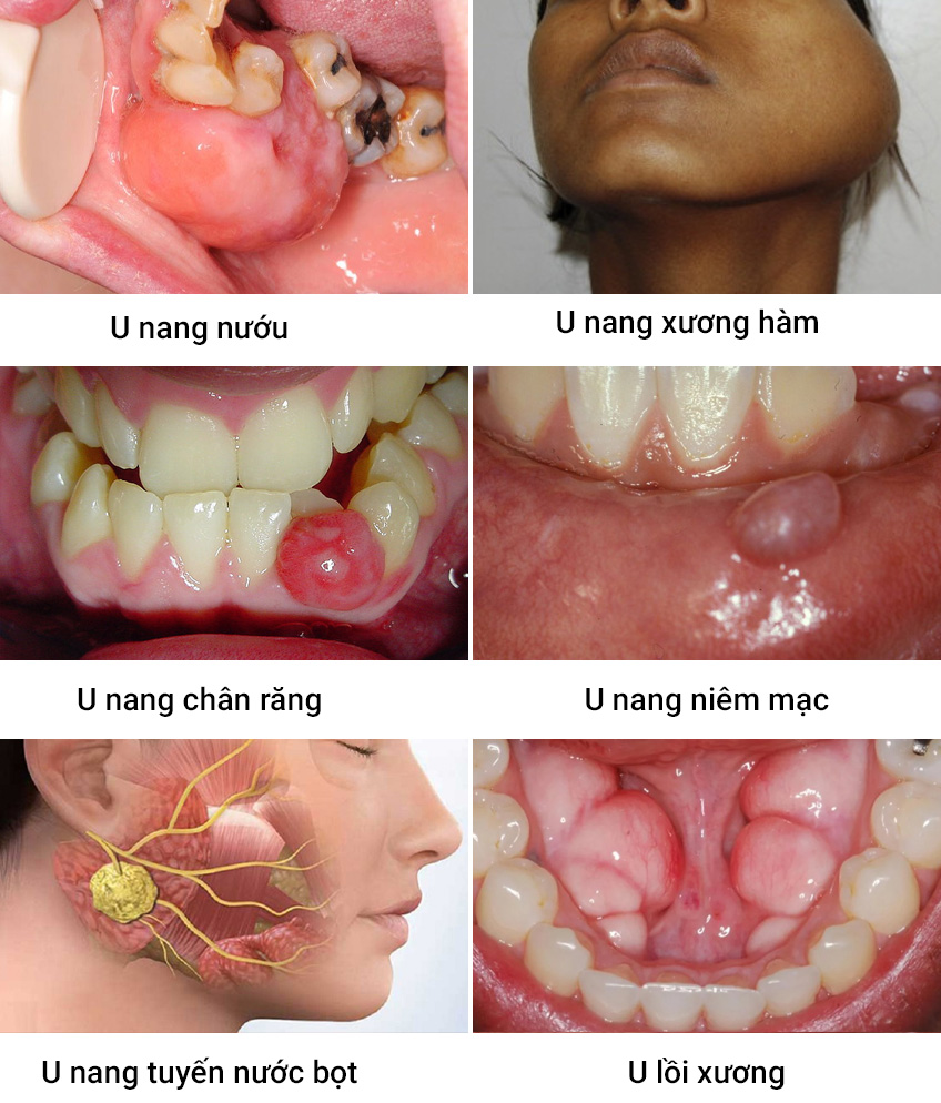 Các dạng u nâng hàm mặt