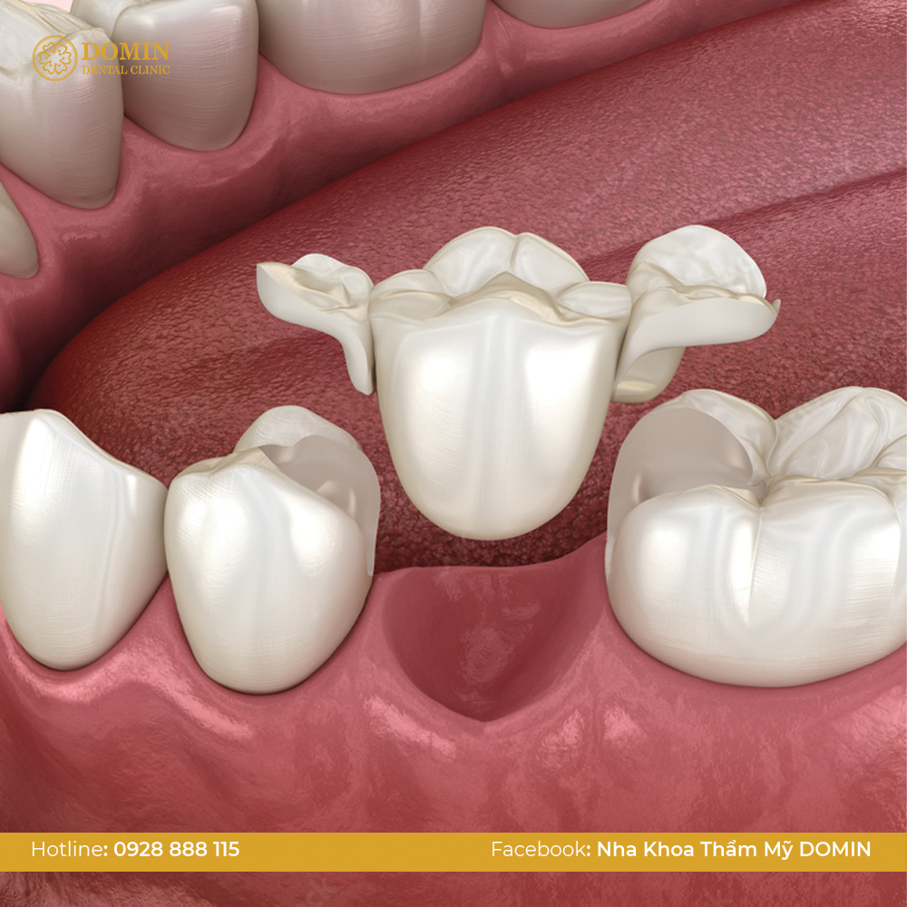 Các loại cầu răng phổ biến