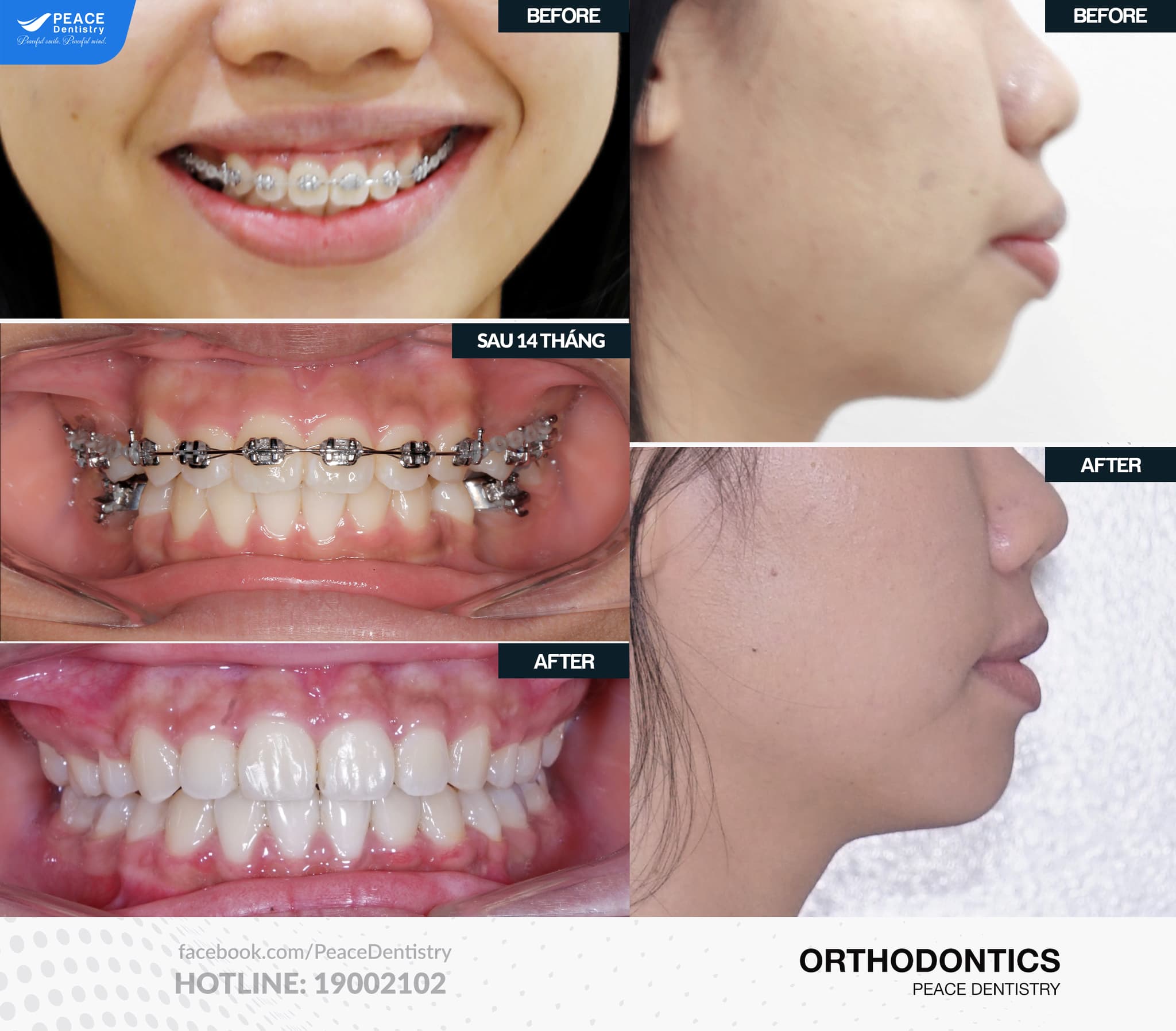 Các phương pháp chỉnh nha cho người lớn