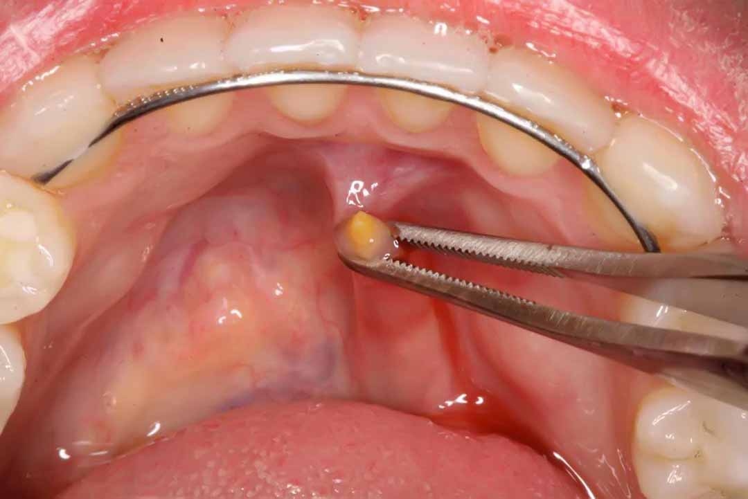 Sỏi tuyến nước bọt