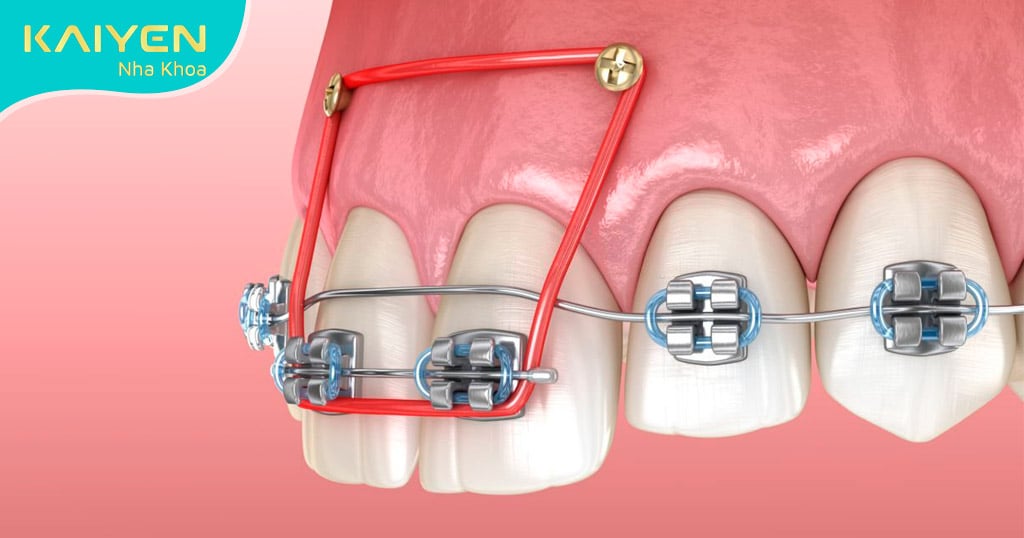 Cắm Minivis Chỉnh Nha