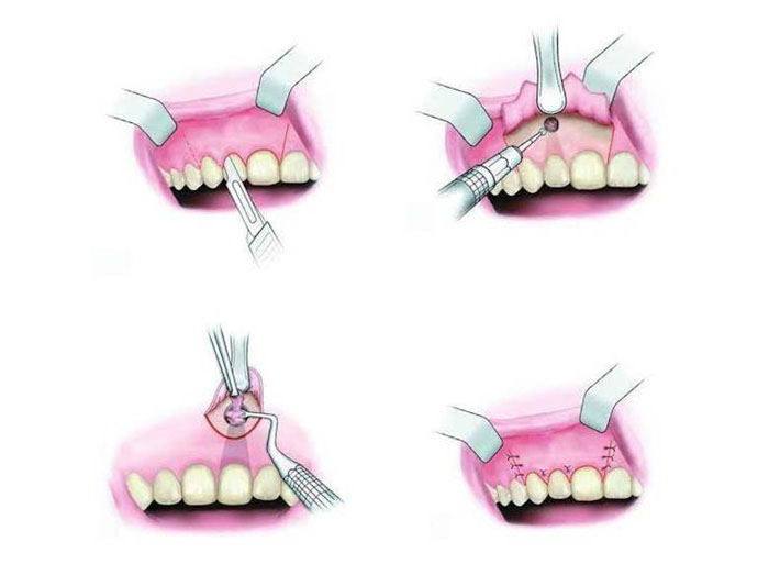 Phẫu thuật cắt chóp răng là gì