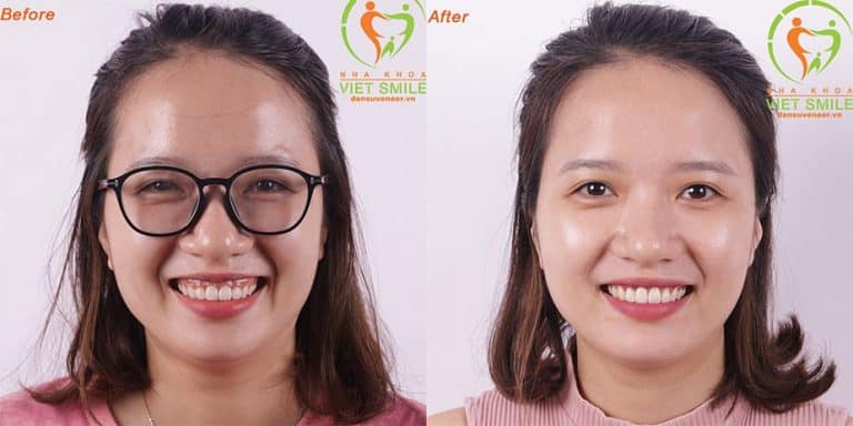 Cắt lợi nha khoa