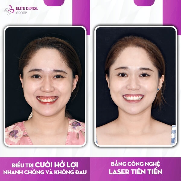 Cắt lợi thẩm mỹ