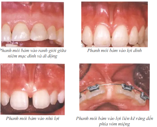 Quy trình cắt phanh môi