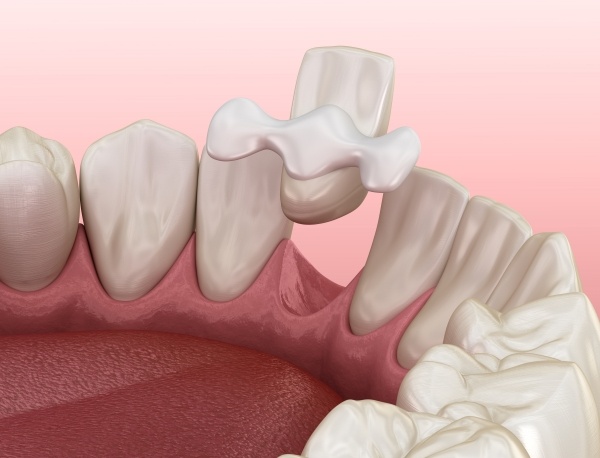 Cầu răng sứ cạnh dán