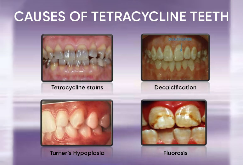Răng nhiễm Tetracycline