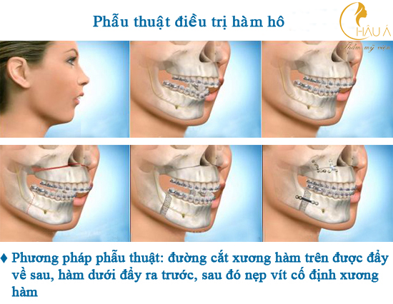 Chỉnh hàm hô