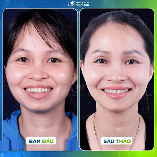Chỉnh nha cho người trưởng thành