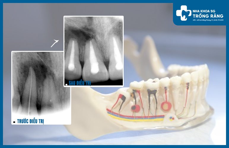 Chẩn đoán viêm quanh chóp bằng X-quang