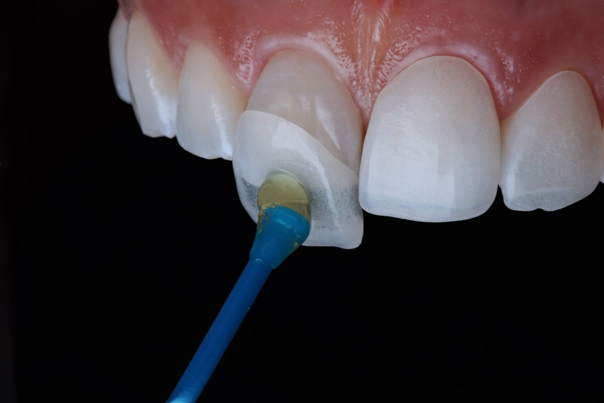Quy trình dán sứ veneer
