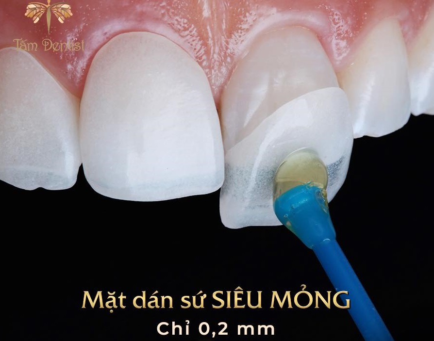 Lợi ích mặt dán sứ siêu mỏng