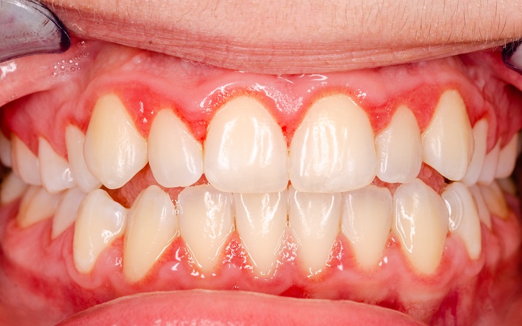Triệu chứng viêm nướu